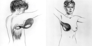 latissimus dorsi reconstruction